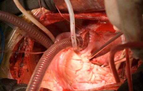 ניתוח מעקפים של העורק השמאלי הראשי ללא שימוש במכונת לב-ריאה מלווה בשיעורי תמותה גבוהים יותר (J Am Coll Cardiol)